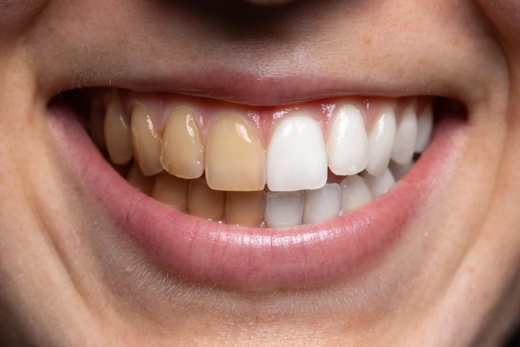Tẩy trắng răng 02