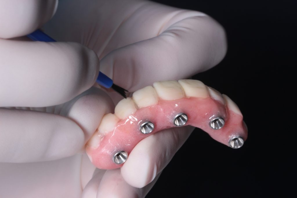 Trồng răng Implant 01