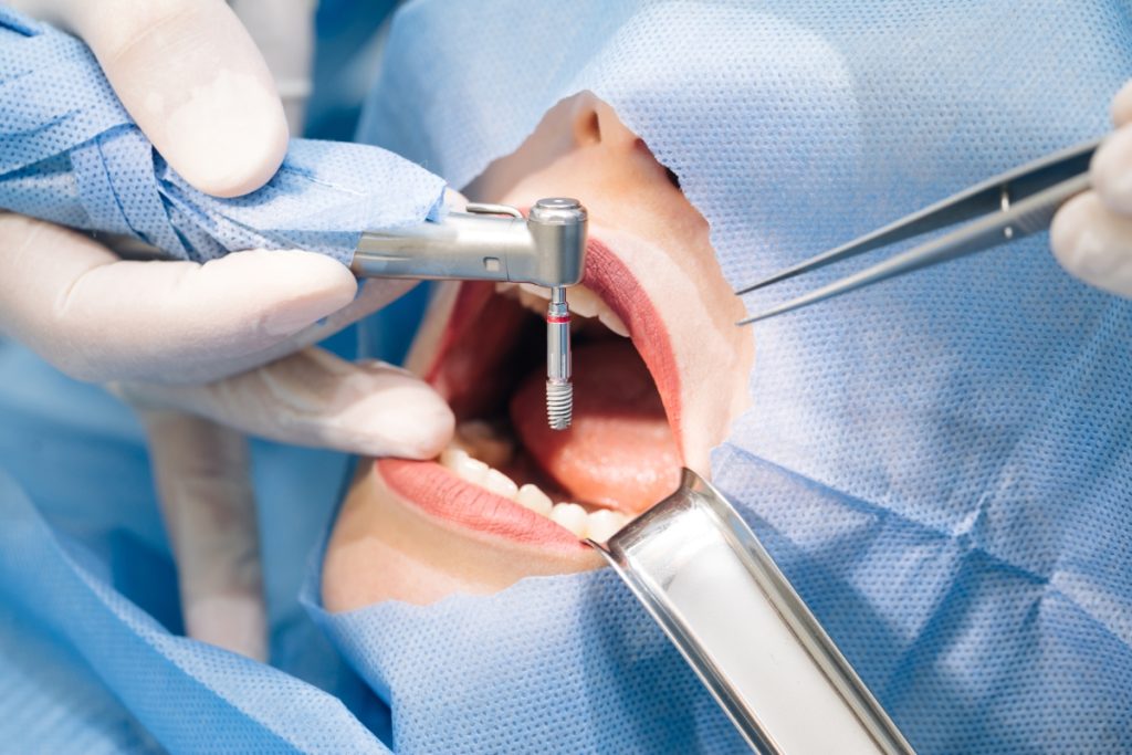 Trồng răng Implant 02