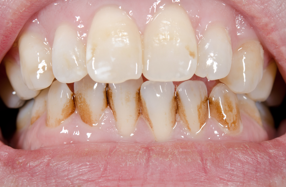 Tẩy trắng răng 01